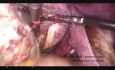 Bloodless Laparoscopic Polymyomectomy