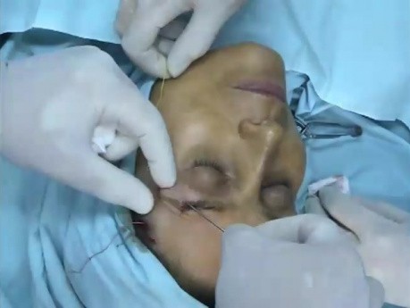 Brow lift using Serdev Suture