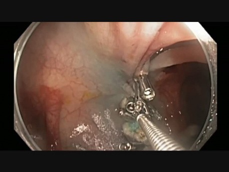 Colonoscopy - Transverse Colon Giant Polyp Resection - Part 2 of 2