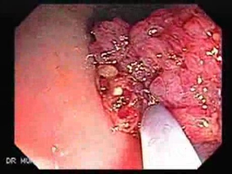 Endoscopic Resection of Giant Tubulo-Villous of the rectum (5 of 35)
