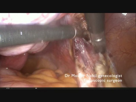 Right Adnexectomy for Solid Ovarian Cyst