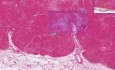 Mural thrombus, infarct - Histopathology of heart