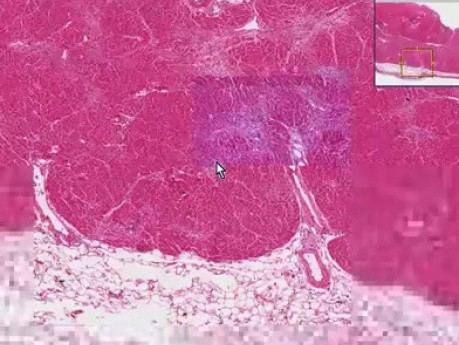 Mural thrombus, infarct - Histopathology of heart