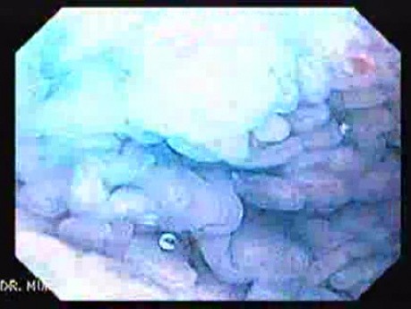 Brunner's Gland Hyperplasia (3 of 5)