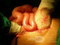 Volvulus Of Small Intestine