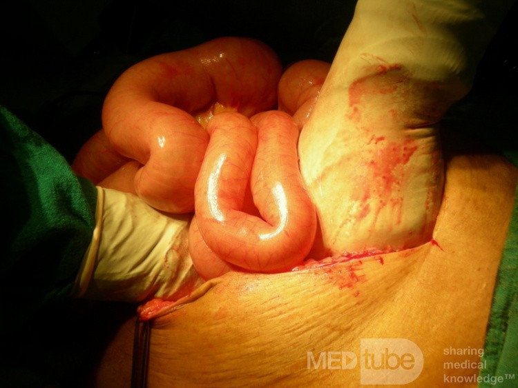 Volvulus Of Small Intestine