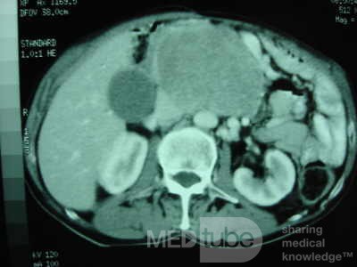 Gastric Ulcer with Gastrocolic fistula due to a Zollinger-
 Ellison Syndrome (29 of 33)