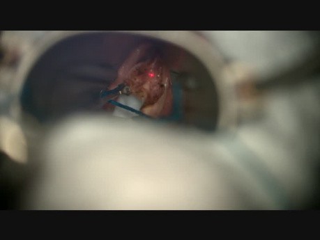 Right Vocal Fold Tumor Resection