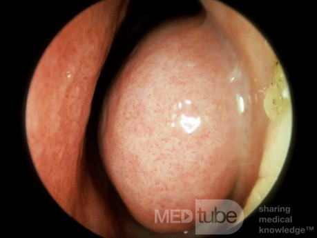 Enlarged Inferior Turbinate 1 [before decongestant application]
