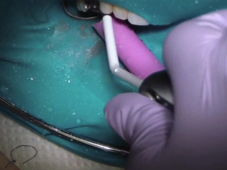 Comprehensive Case #1 - First Appointment - Post Removal And Permaflow Purple
