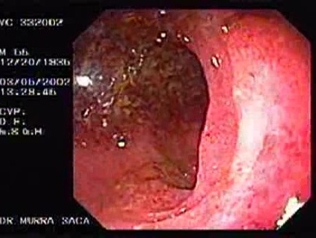 Rectal Bleeding (2 of 2)