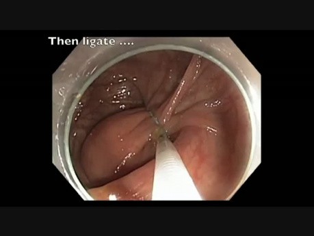 Colonoscopy Channel - Ligation of a Giant Colon Lipoma
