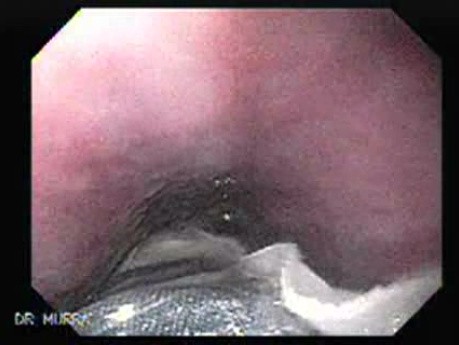 Intragastric Balloon - The Treatment Of Obesity (1 of 13)
