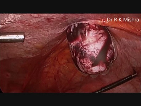 Laparoscopic Tissue Retrieval