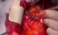 Post Heart Transplantation Redo CABG off Pump with LIMA to LAD