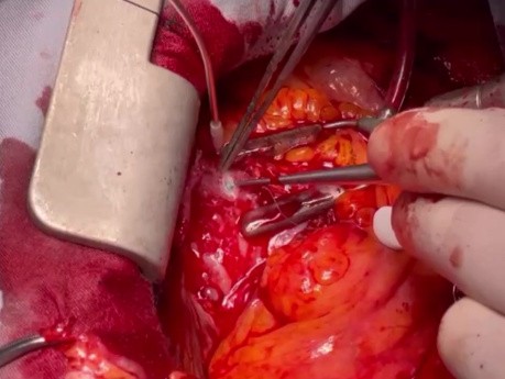 Post Heart Transplantation Redo CABG off Pump with LIMA to LAD