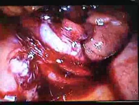 Jejunal Gastrointestinal Stromal tumor (GIST) (66 of 86)