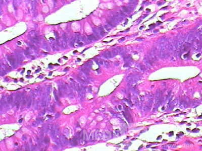 Endoscopic Resection of Giant Tubulo-Villous of the rectum (29 of 35)
