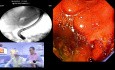 Beyond the Duodenoscope: Optimizing Outcomes with Direct Peroral Cholangioscopy in Complex Biliary Cases