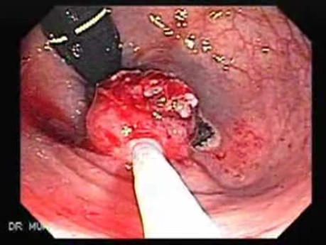 Tubulo - Villous Rectal Adenoma - Endoscopy (19 of 35)