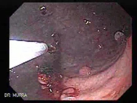 Gastric Polyposis - Endoscopy (8 of 11)