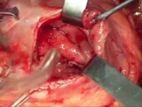 Gastroenteral anastomosis done by circular stapler