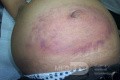 The Cullen sign, periumbilical ecchymosis (1 of 2)