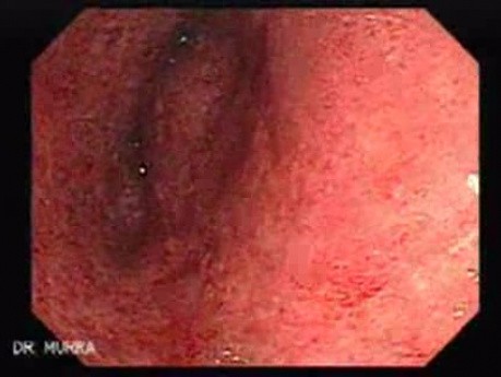 Colitis Ulcerosa - Pseudopolyps (18 of 22)