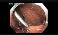 Colonoscopy Channel - Delayed Postpolypectomy Bleeding After A Large Rectal EMR