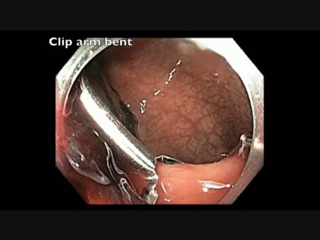 Colonoscopy Channel - Delayed Postpolypectomy Bleeding After A Large Rectal EMR