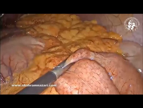 One Anastomosis Gastric Bypass as Redo Surgery After Failed Sleeve Gastrectomy