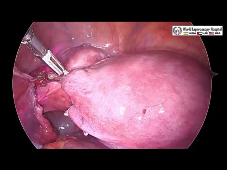 Total Laparoscopic Hysterectomy by Three Port and Infrared Ureteric Catheter