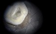Maxillary Molar Endo Access - Ultrasonic MB2 Troughing Microscope