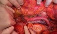 Precaval Right Renal Artery During Lymphadenectomy for Endometrial Cancer