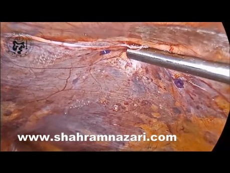 Laparoscopic Bilateral Direct Hernia