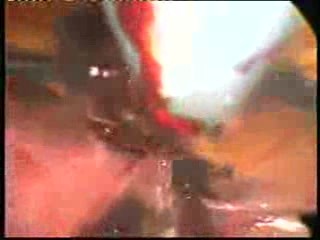 Laparoscopic Salpingectomy For A Ruptured Ectopic Pregnancy