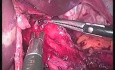 Cardiomyotomy with Anterior Fundoplication - SILS 