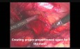 Laparoscopic Inguinal Hernia TAPP Repair