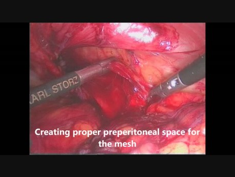 Laparoscopic Inguinal Hernia TAPP Repair