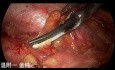 Dual-port Trans-subclavian Thyroid Endoscopic Surgery (Part 6)