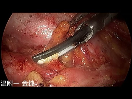 Dual-port Trans-subclavian Thyroid Endoscopic Surgery (Part 6)