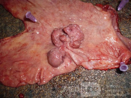 Polypoid Adenocarcinoma (9 of 9)