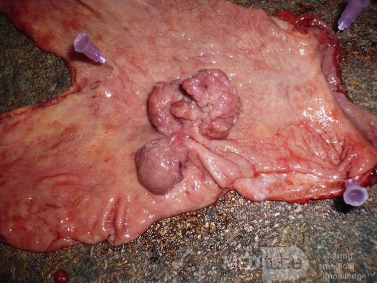 Polypoid Adenocarcinoma (9 of 9)