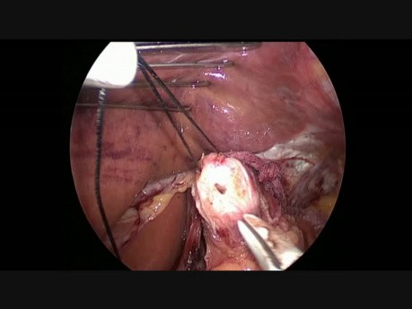 Laparoscopic Enucleation of Distal Esophageal Leiomyoma; Nissen Fundoplication