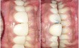 Composite Veneer