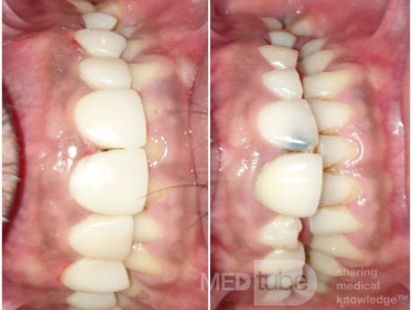 Composite Veneer