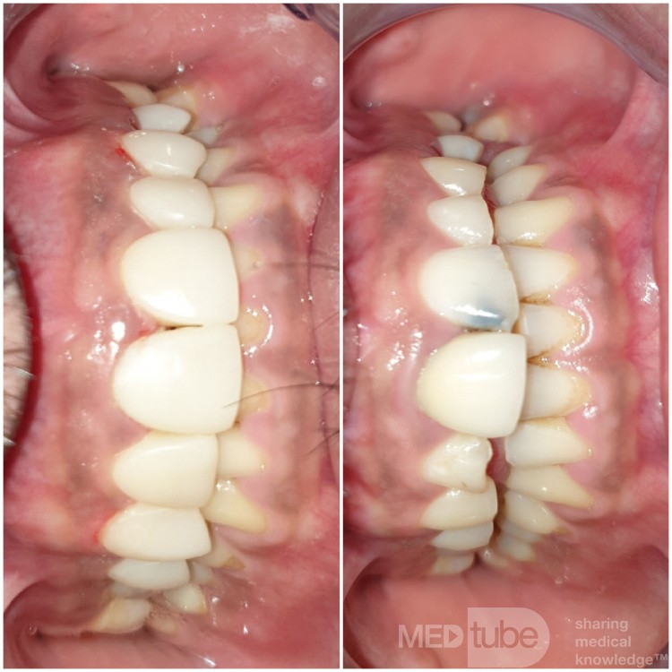Composite Veneer