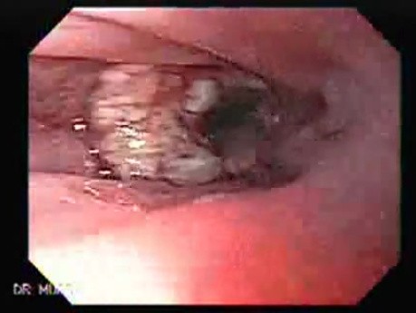 Esophageal Squamous Cell Carcinoma (5 of 5)