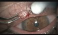 Excision of a Nodule on the Lid Margin