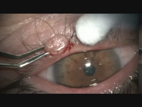 Excision of a Nodule on the Lid Margin